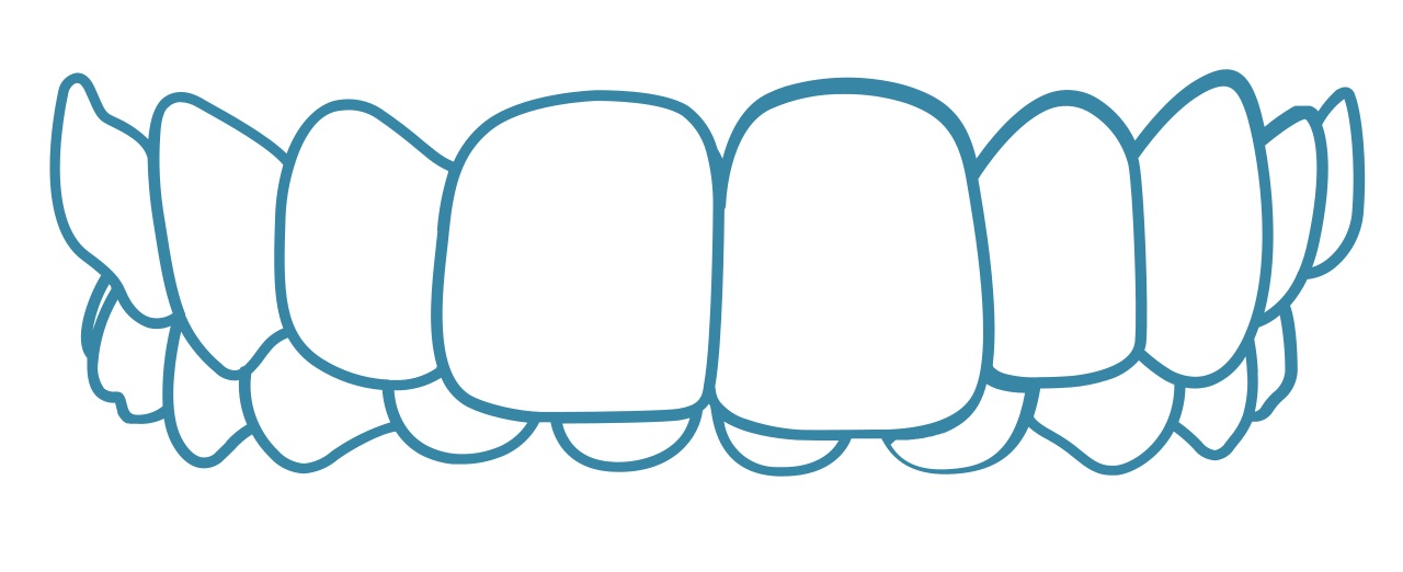 Invisalign-Overbite-dental-care-arlington-heights