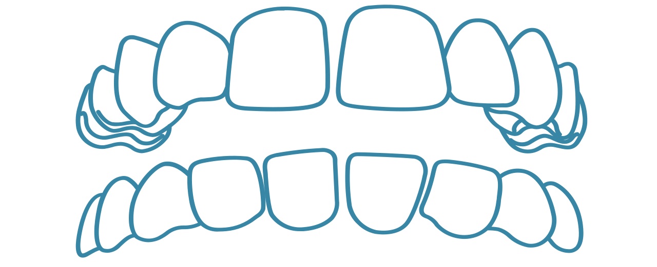 Invisalign-gap-teeth-dental-care-arlington-heights