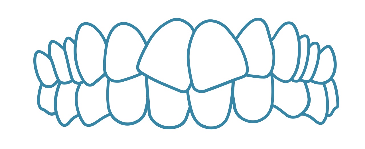 Invisalign-generally-striaght-teeth-dental-care-arlington-heights