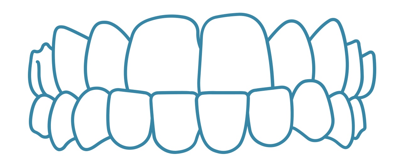 Invisalign-underbite-dental-care-arlington-heights