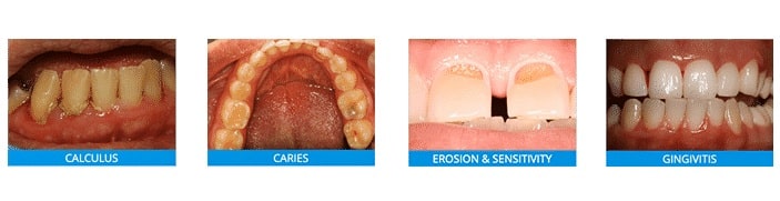 dental-care-arlington-heights-general-dentistry-fluoride-1X4