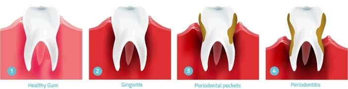 dental-care-arlington-heights-gum-disease-stages-long