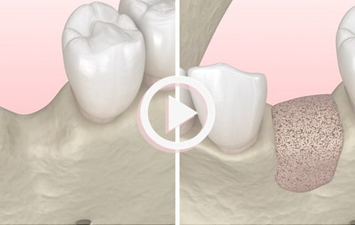 dental-implant-video-image-bone-grafing-dental-care-arlington-heights