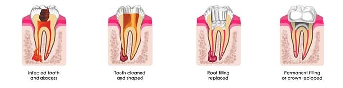 general-dentistry-root-canal-1X4-dental-care-arlington-heights