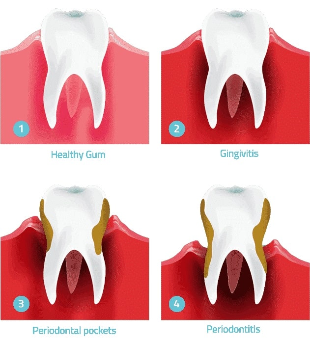 gum-disease-stages-dental-care-arlington-heights
