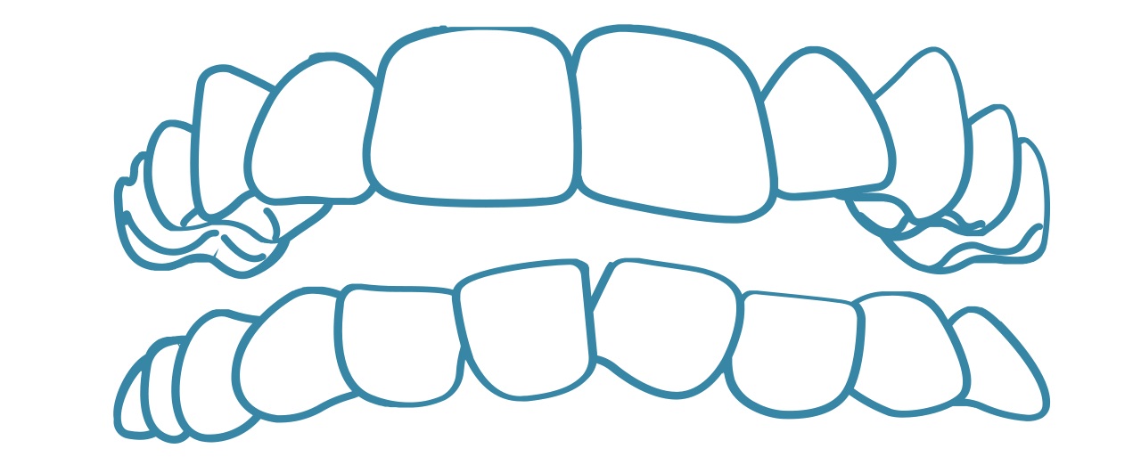 invisalign-crooked-teeth-dental-care-arlington-heights