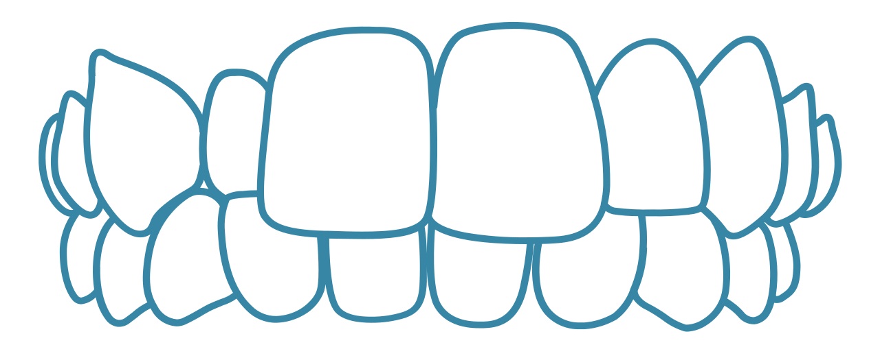 invisalign-crossbite-dental-care-arlington-heights