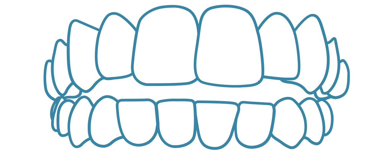 invisalign-open-bite-dental-care-arlington-heights
