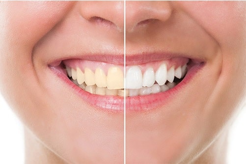 cosmetic-dentistry-teeth-whitening-dental-care-mount-prospect