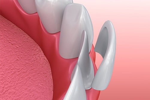 cosmetic-dentistry-veneers-dental-care-mount-prospect-02