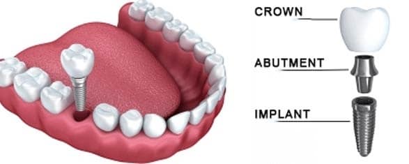 dental-implants-Crown-Abutmet-Implant-dental-care-mount-prospect