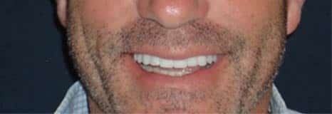 dentist-near-me-after-cosmetic-dentistry-dental-care-mount-prospect